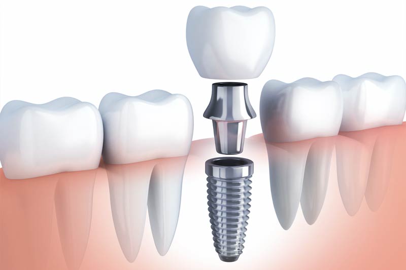 Implants Dentist in Davis