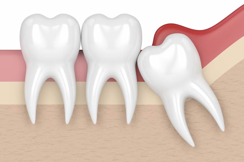 Wisdom Tooth Removal in Davis